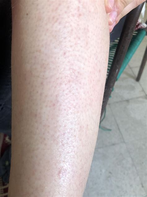 Skin Concern Red Bumps All Over Lower Legs Not Raisedswollenwhat