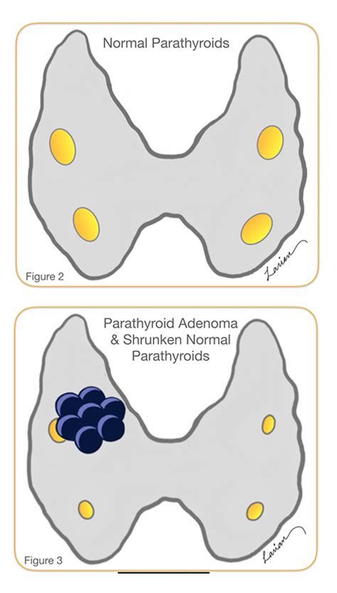 Parathyroidectomy Parathyroid Gland Removal Surgery Dr Larian