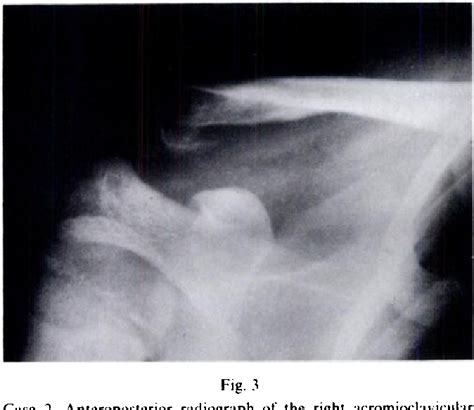 Figure 3 From Pseudodislocation Of The Acromioclavicular Joint S