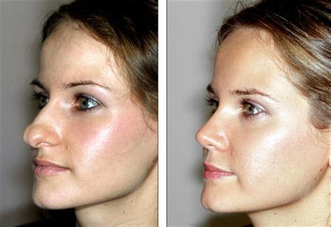 Before And After Pictures Show How A Nose Job Can Change Your Face Others