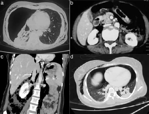 Computed Tomography Ct Scan Shows A Right Pneumothorax With Passive