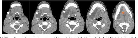 Figure 2 From A Rare Case Of Submandibular Mucocele Extending Into The