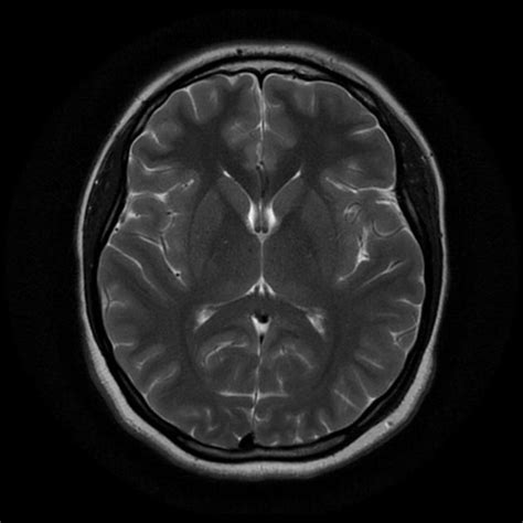 Normal Brain Mri Radiology Case Pediatric
