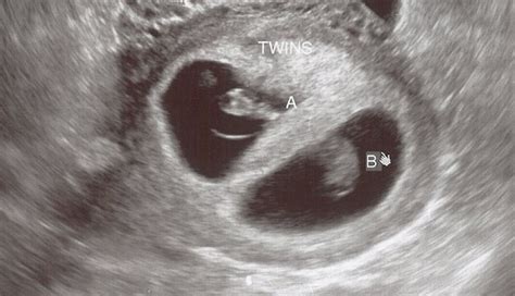 The Twins First Trimester Checklist Twiniversity