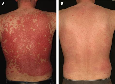 5 years ago5 years ago. Newer agents for psoriasis in adults | The BMJ