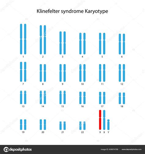 Síndrome Klinefelter Xxy Cariótipo Humano imagem vetorial de