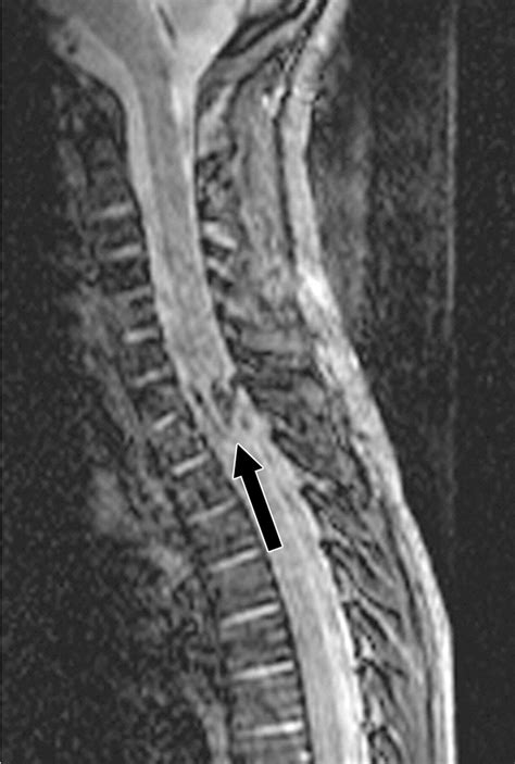 Spectrum Of Imaging Findings In Hyperextension Injuries Of The Neck