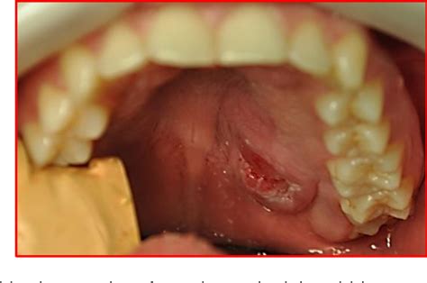 Figure 1 From Juvenile Intraoral Pleomorphic Adenoma Of The Soft Palate