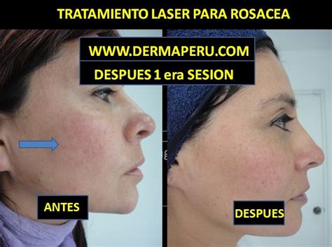Tratamiento Laser Vascular Para Rosacea Dermaperu