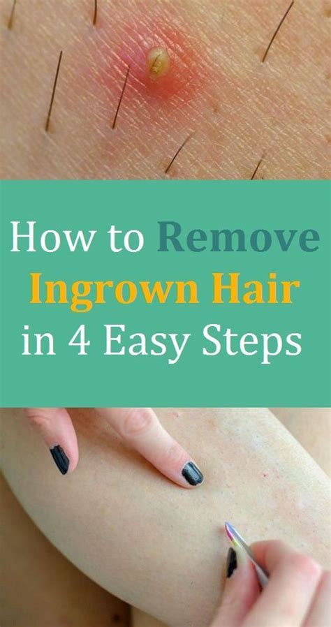How To Remove Ingrown Hair In 4 Easy Steps Ingrown Hair Removal Ingrown Hair How To Remove
