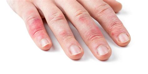 ¿qué Es La Dermatitis En Las Manos Consejos Halibut