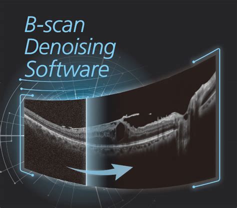 Software B Scan Denoising Para A Série Oct Nidek