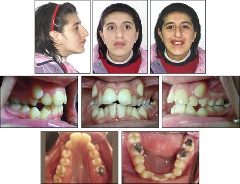 Functional And Fixed Orthodontic Treatment In A Child With Cerebral