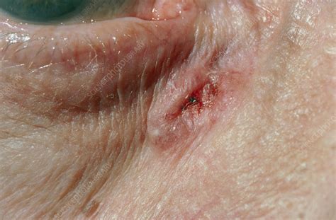 Rodent Ulcer Near Eye Stock Image M1310160 Science Photo Library