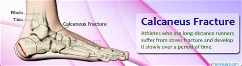 Calcaneus Fracture Or Broken Heeltreatmentrecovery