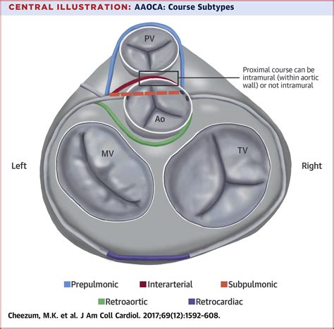 Anomalous Aortic Origin Of A Coronary Artery From The Inappropriate