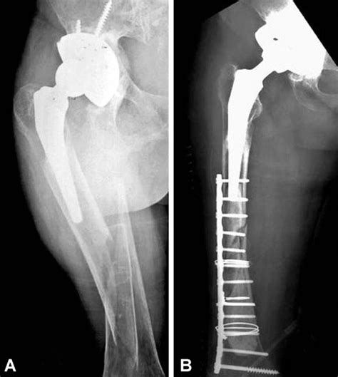 Periprosthetic Femoral Fractures After Hip Arthroplasty