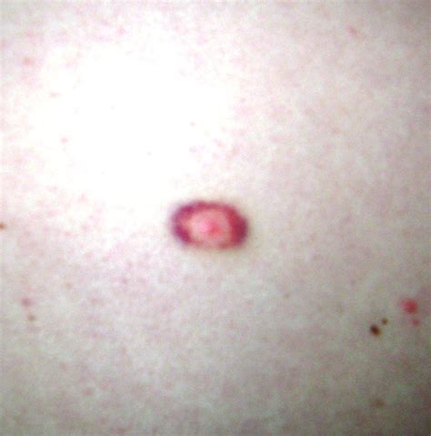Bullseye Rash Arklatex Lyme And Tick Borne Disease Prevention And Support