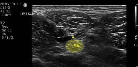 Popliteal Sciatic Nerve Block Em Ultrasound Section