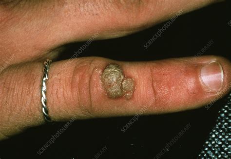 Common Wart Stock Image M2900131 Science Photo Library