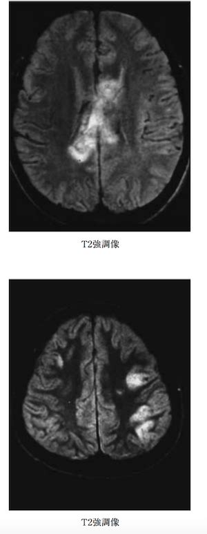 Dai is one of the most common and devastating types of traumatic brain injury and is a major cause of unconsciousness and persistent vegetative state after. びまん性軸索損傷とは？画像診断のポイントは？