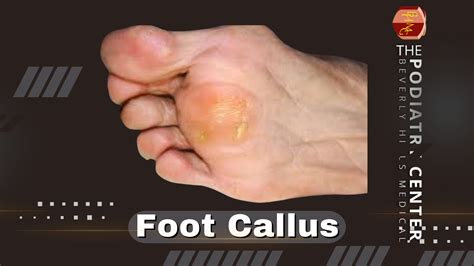 Understanding Foot Callus Causes Treatment And Prevention Podiatry