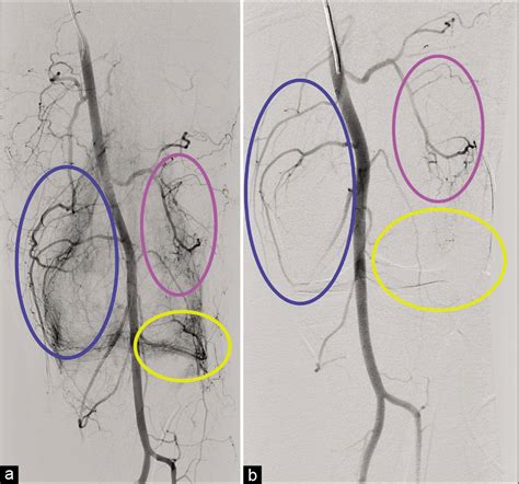 Geniculate Artery Embolization For The Treatment Of Refractory Hemarthrosis Following Meniscal