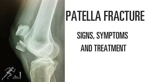 Patella Fracture Mechanism Of Injury Signs And Symptoms And Treatment