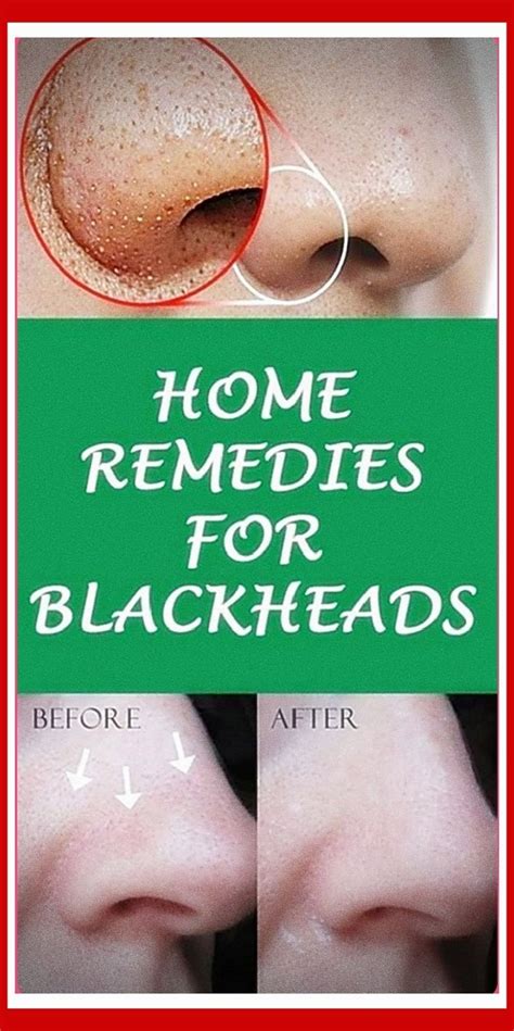 Remove Blackheads With One Simple And Effective Trick Solution For