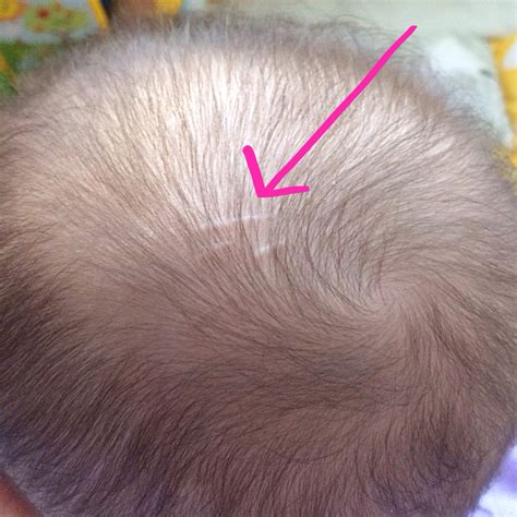 Lines On Scalp — The Bump