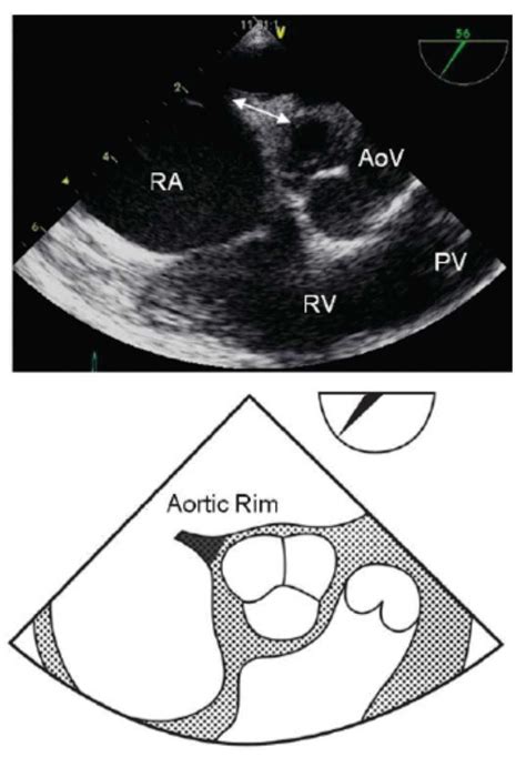 Multiplanar Transesophageal Echocardiography For The Evaluation And