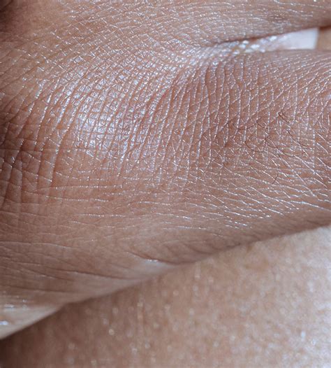 Dry Skin 101 Causes Symptoms And Winter Protection Tips