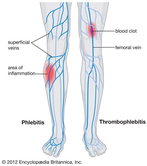 Pin On Venous And Other Health