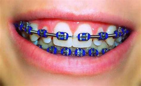 What Are Some Helpful Tips To Select The Ideal Color Braces Choose The Most Popular Top Braces