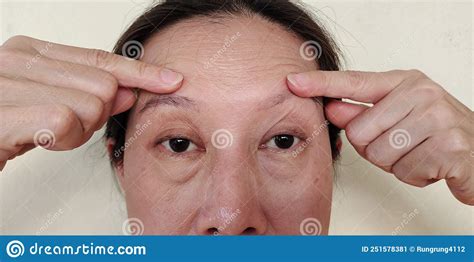 The Flabby Sagging And Forehead Lines On The Face Stock Image Image