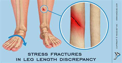 Lower Leg Stress Fracture Bone