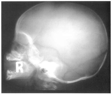 Nasal Bone Fracture Child X Ray What Is The Best Imaging Study To
