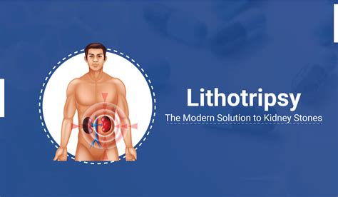 Lithotripsy The Modern Solution To Kidney Stones