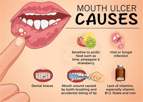 What Causes Canker Sores Yoors