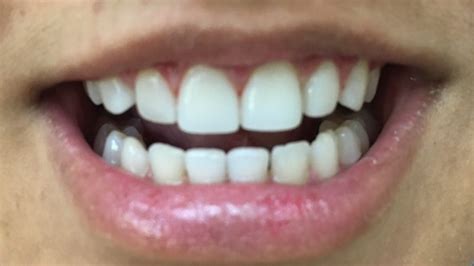 Gaps Between The Upper And Lower Front Teeth Menlo Park Dentist