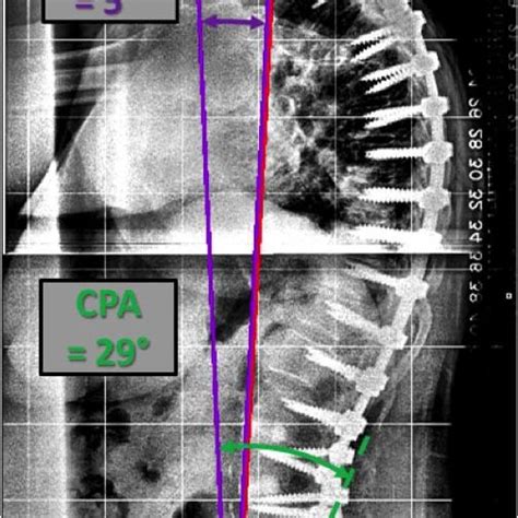 Cervical Radiographic Parameters Measured Including The Cervical