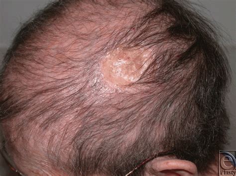 Single Stage Full Thickness Scalp Reconstruction Using Acellular Dermal