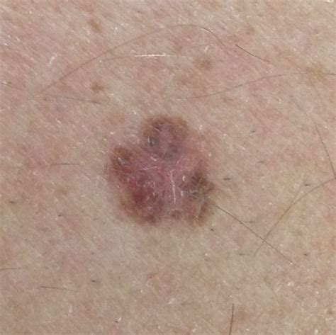 What Does The First Stage Of Skin Cancer Look Like Indiana Woman Left