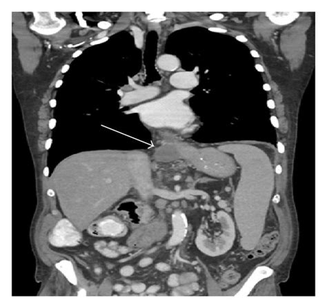 A Intravenous Contrast Enhanced Axial Ct Scan Of The Abdomen