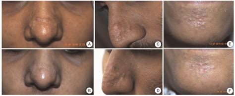 Ablative Carbon Dioxide Laser Treatment For Papular Scars Of Nose And Chin Due To Acne A Case