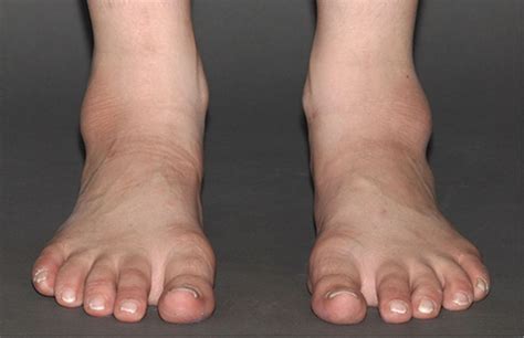 ‘coal Miners Ankle In A Child Bilateral Malleolar Bursitis