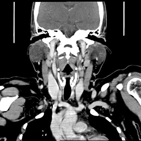 Ct Neck Coronal Contrast Radrounds Radiology Network