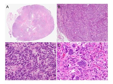 Combined Large Cell Neuroendocrine Carcinoma With Giant Cell Carcinoma