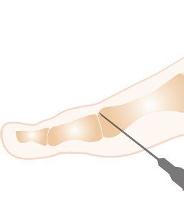 A propos de la chirurgie mini invasive et percutanée du pied