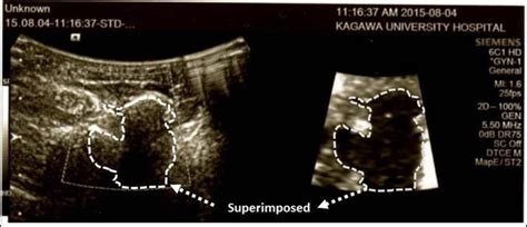 Ultrasound Images Of A Breast Lesion Image Of The Lesion Shown Using